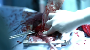 Bleeding in surgery